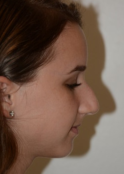 Before Image: Rhinoplasty – Case 11 - other