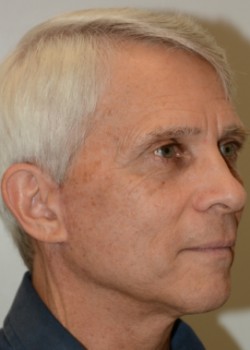 After Image: Facelift – Case 2 - other