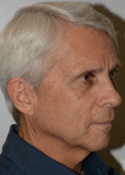 Before Image: Facelift – Case 2 - other