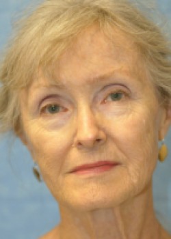 Before Image: Facelift – Case 3