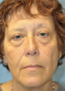 Before Image: Facelift – Case 8 - front