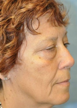 Before Image: Facelift – Case 8 - front