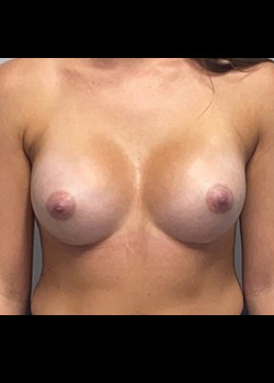 Breast Augmentation – Case 39