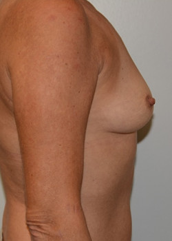 Breast Augmentation – Case 40
