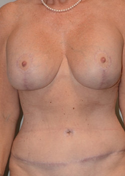 Mastopexy/Abdominoplasty Case 11