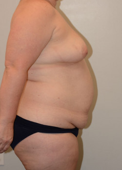 Mommy Makeover/Tummy Tuck/Liposuction/Breast Augmentation
