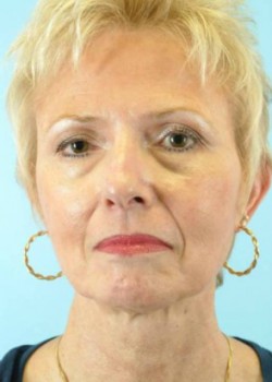 Before Image: FACELIFT – CASE 14 - front