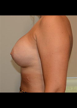 After Image: Breast Augmentation – Case 44 - other