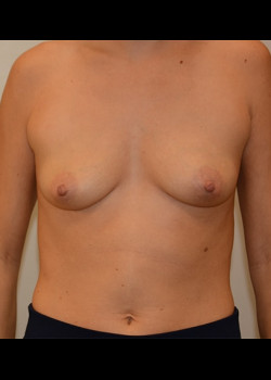 Breast Augmentation – Case 45