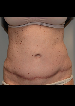 Abdominoplasty – Case 13