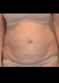 Abdominoplasty – Case 13