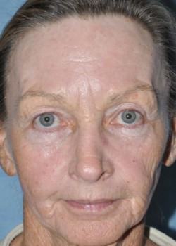 After Image: CO2 LASER – CASE 2 - front