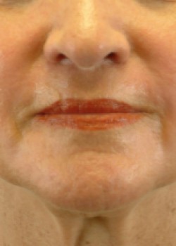 After Image: CO2 LASER – CASE 3 - front