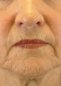 Before Image: CO2 LASER – CASE 3 - front