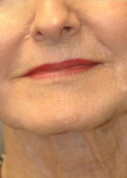 After Image: CO2 LASER – CASE 4