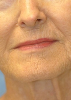 Before Image: CO2 LASER – CASE 4