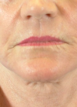 After Image: CO2 LASER – CASE 5