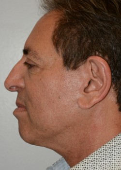 After Image: Necklift – Case 1 - other
