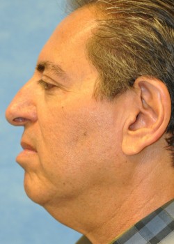 Before Image: Necklift – Case 1 - other