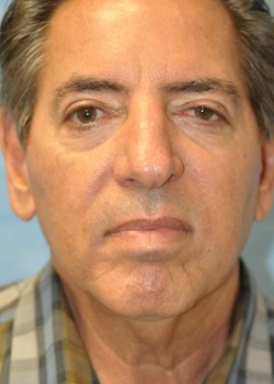 Before Image: Necklift – Case 1 - front