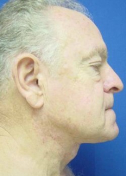 Necklift – Case 7