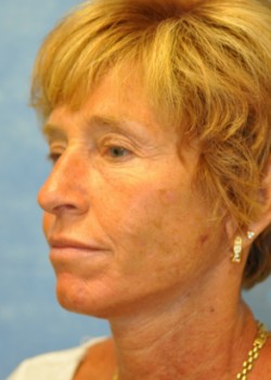 After Image: Necklift – Case 10 - other