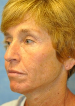 Before Image: Necklift – Case 10 - other