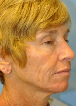 Before Image: Necklift – Case 10 - right-front-oblique