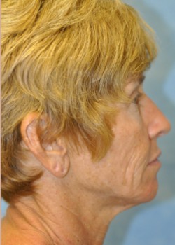 Before Image: Necklift – Case 10 - right-side