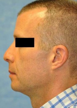 After Image: Rhinoplasty – Case 2 - left-side