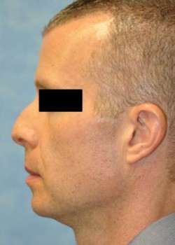 Before Image: Rhinoplasty – Case 2 - left-side