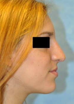 After Image: Rhinoplasty – Case 4 - left-side