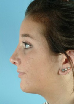 After Image: Rhinoplasty – Case 5 - left-side