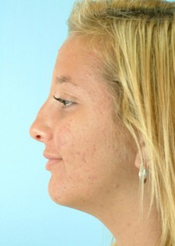 Before Image: Rhinoplasty – Case 5 - left-side