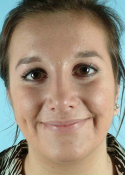 After Image: Rhinoplasty – Case 5 - front