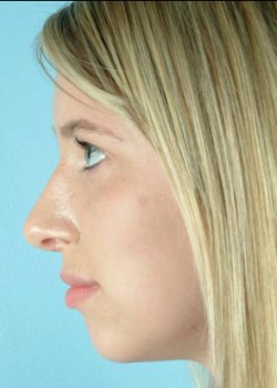 After Image: Rhinoplasty – Case 7 - front