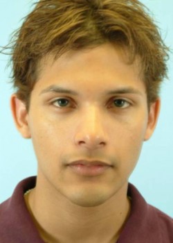 After Image: Rhinoplasty – Case 8 - front