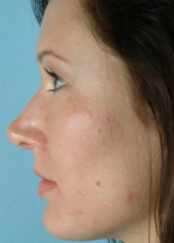 Rhinoplasty – Case 9