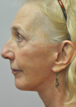 Chin Implant – Case 1