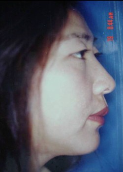 After Image: Chin Implant – Case 2 - front
