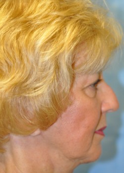 After Image: Chin Implant – Case 3