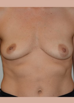 Breast Augmentation – Case 1