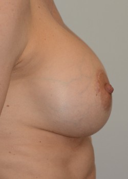 After Image: Breast Augmentation – Case 1 - other