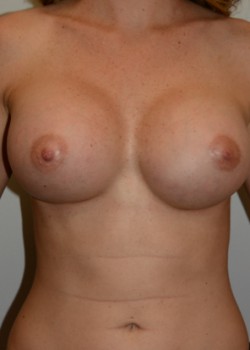 After Image: Breast Augmentation – Case 5 - front