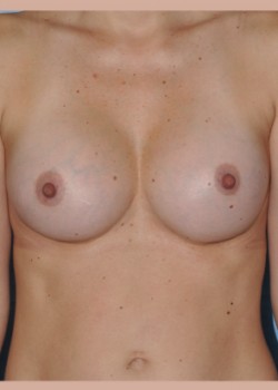After Image: Breast Augmentation – Case 7 - front