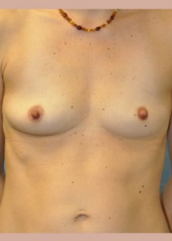 Before Image: Breast Augmentation – Case 7 - front