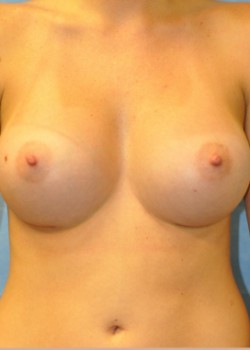 Breast Augmentation – Case 9