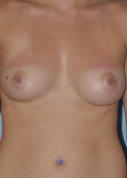 Breast Augmentation – Case 9