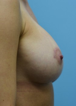 Breast Augmentation – Case 11