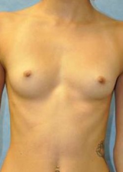 Breast Augmentation – Case 13